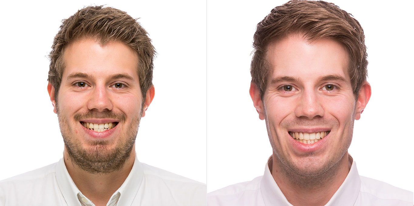 erwachsene-vorher-nachher-5