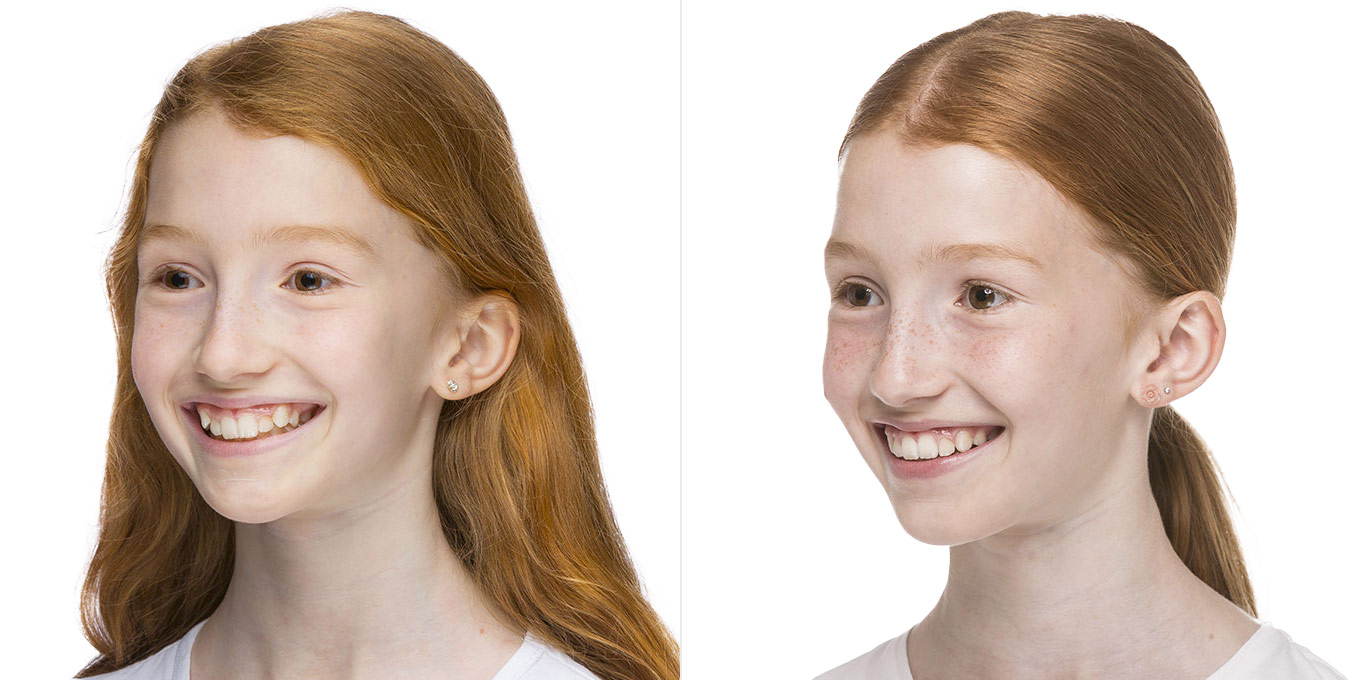 teen-vorher-nachher-2