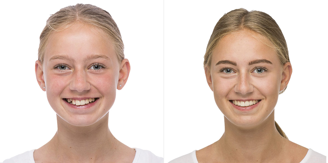 teen-vorher-nachher-3