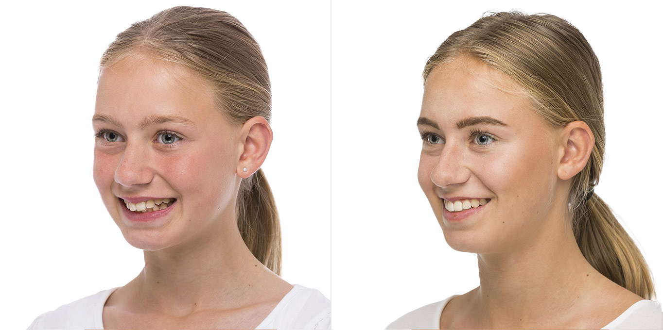 teen-vorher-nachher-4