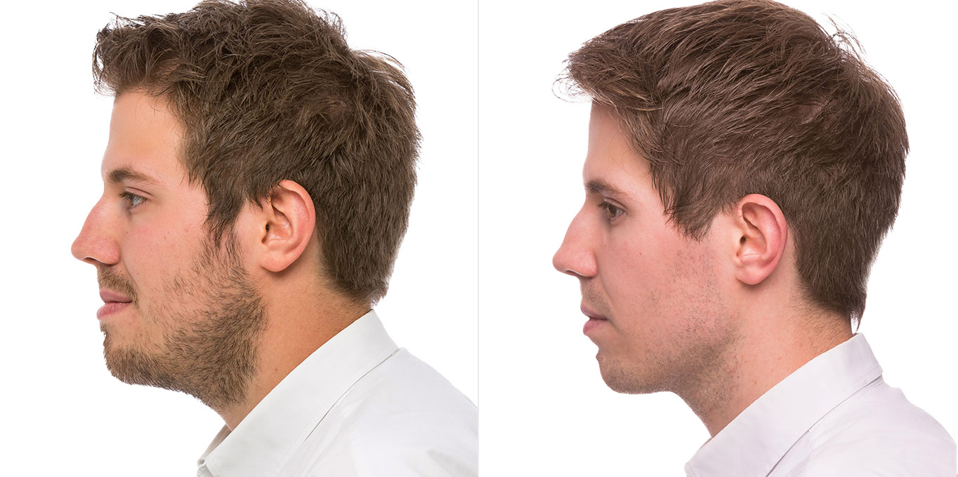 erwachsene-vorher-nachher-6